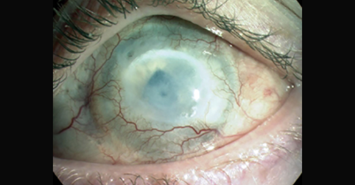 Management Of Ocular Chemical Burns