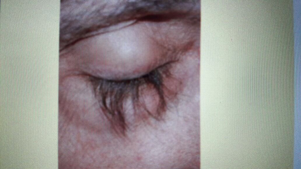 Eyelash Trichomegaly Following Treatment With Erlotinib