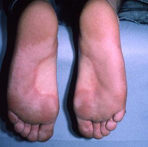 Identify The Itchy Feet