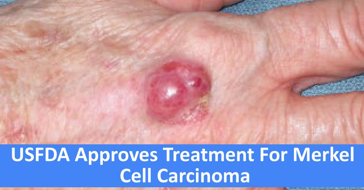 USFDA Approves Treatment For Rare Form Of Skin Cancer