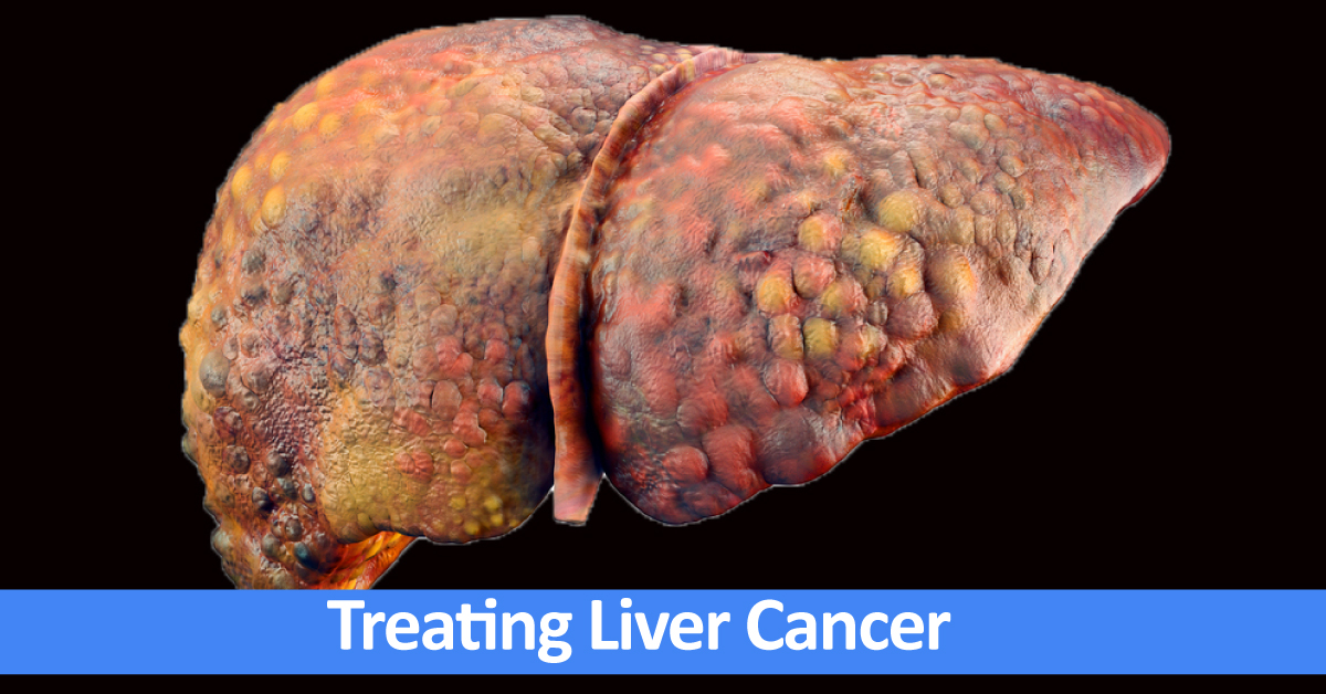 Treatment Of Heptocelluar Carcinoma