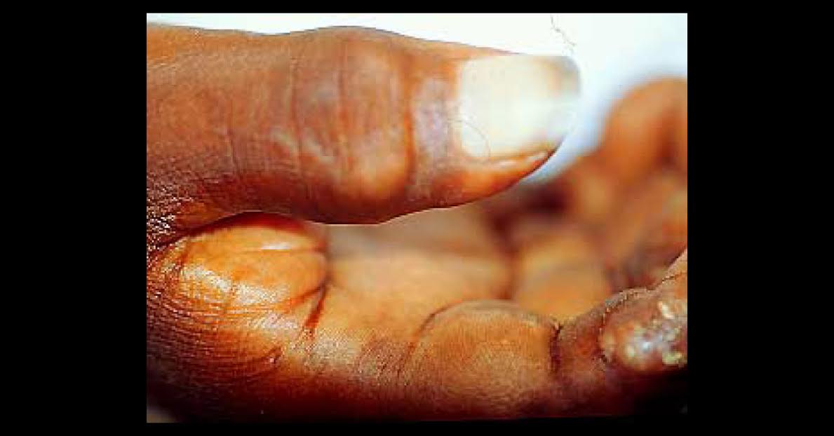 Pus Bumps On Hands