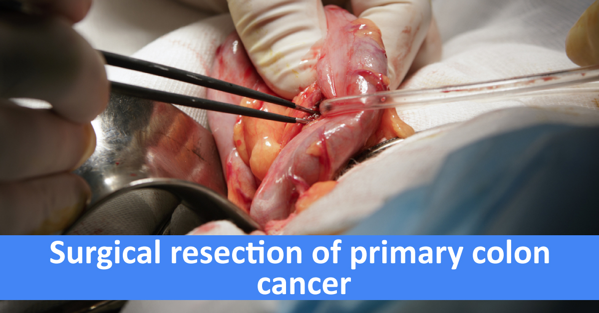 Surgical Resection Of Primary Colon Cancer