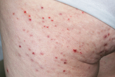 Identify the Blistering rash