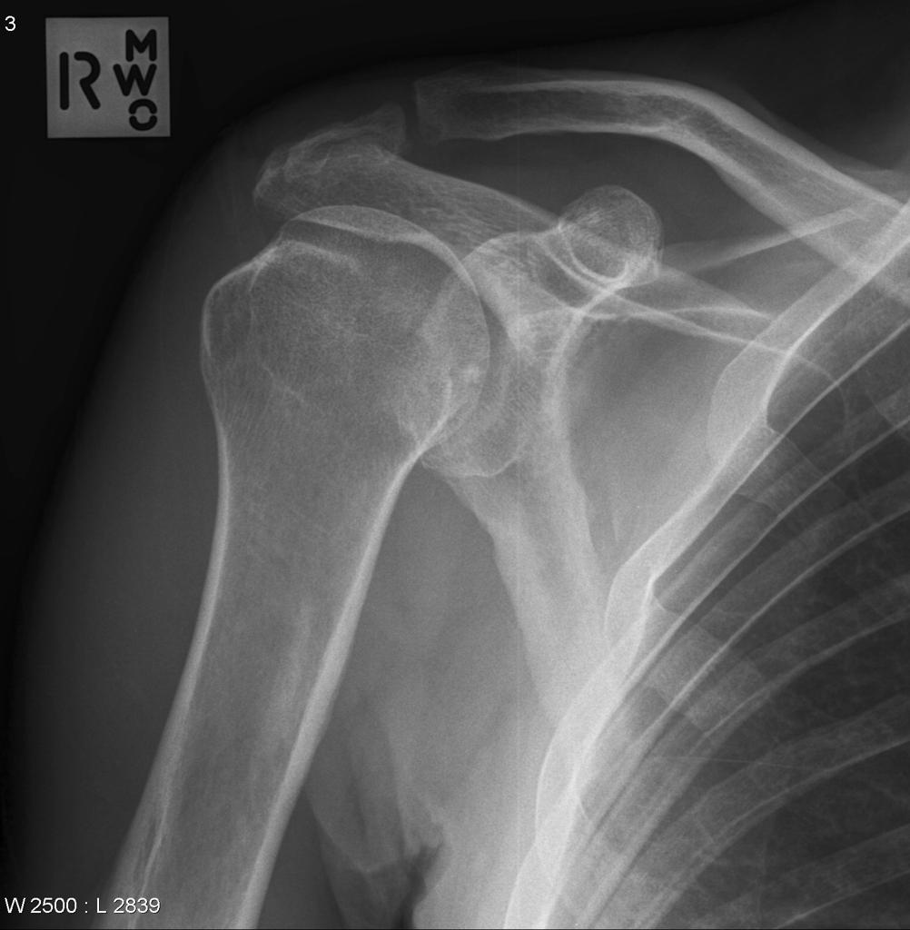 Spot The Shoulder Condition