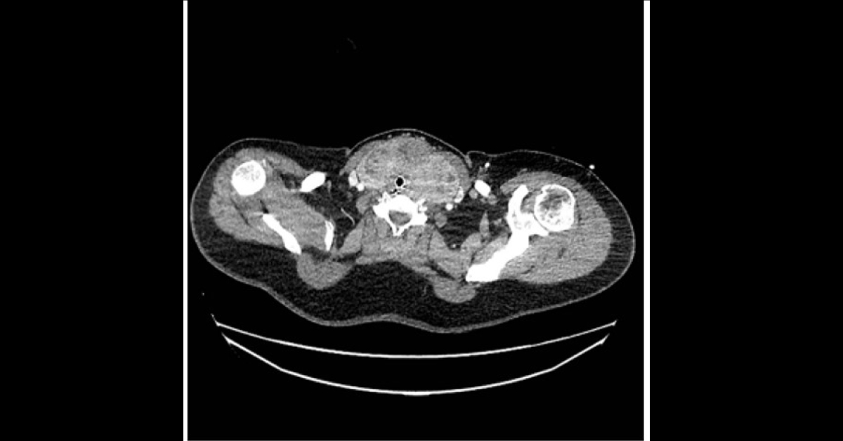 A Mystical Cause Of Dyspnoea