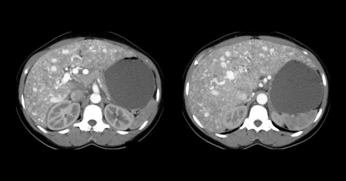 Identify The Cause Of Nose Bleeding From Radiograph