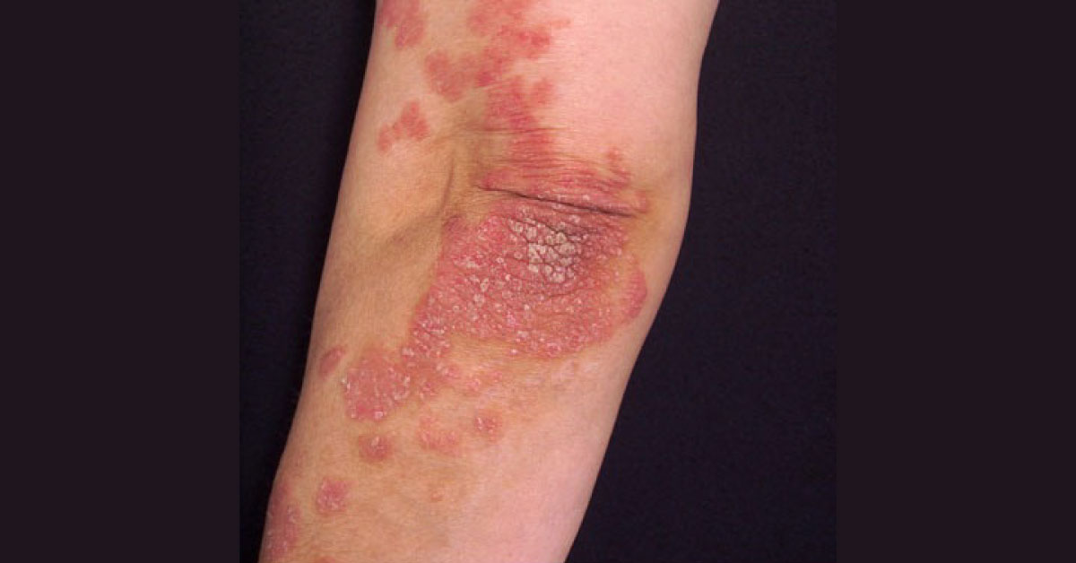 Spot The Skin Lesion