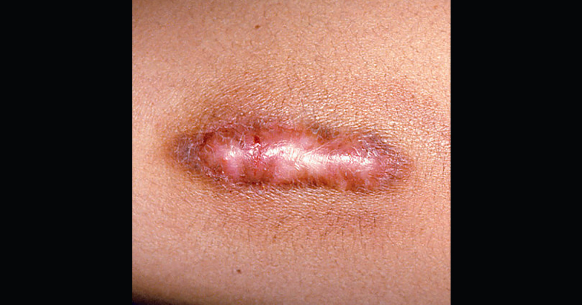 Identify The Lesion