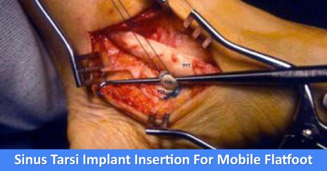 Sinus Tarsi Implant Insertion For Mobile Flatfoot