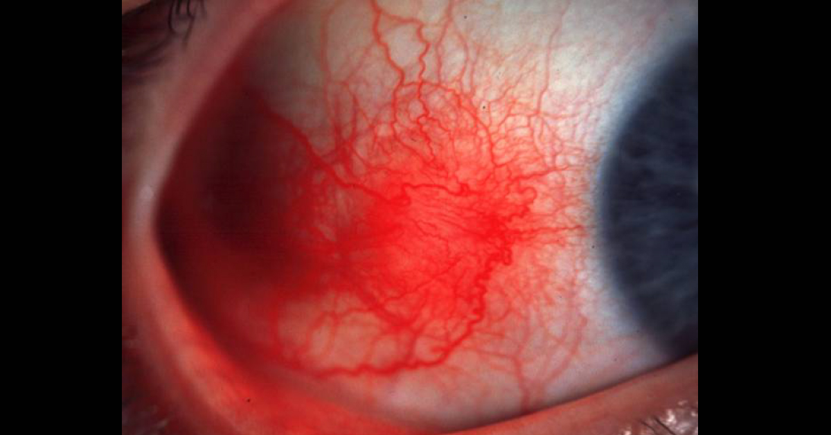 Spot The Ophthalmic Condition