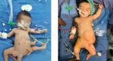 Baby Born With Eight Limbs Successfully Operated In India
