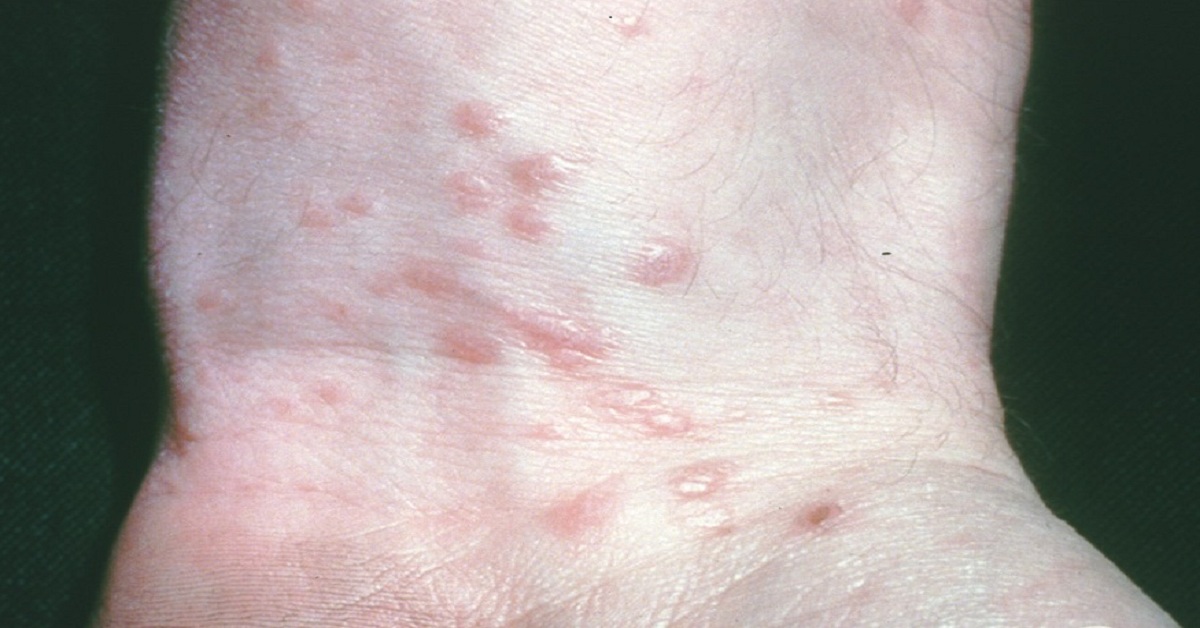 Lichens Planus In Indian Patients
