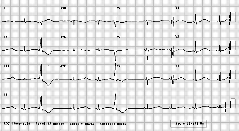 Identify The Abnormality From The ECG