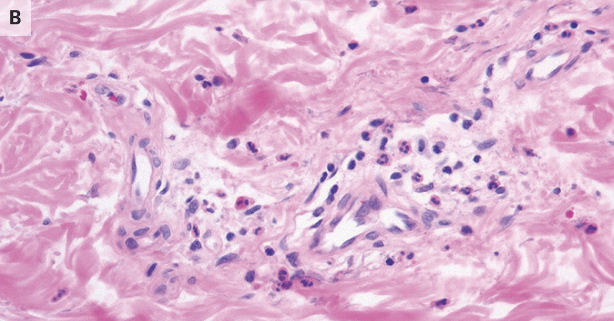 A Fever With Red Annular Macules