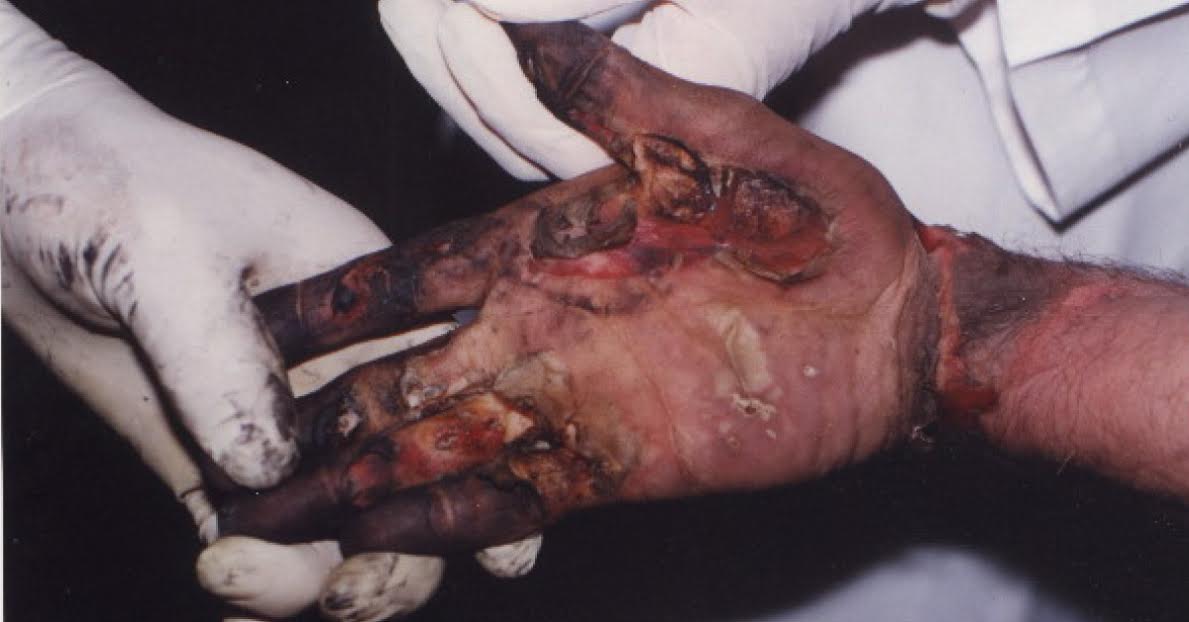 Identify The Cause Of Death