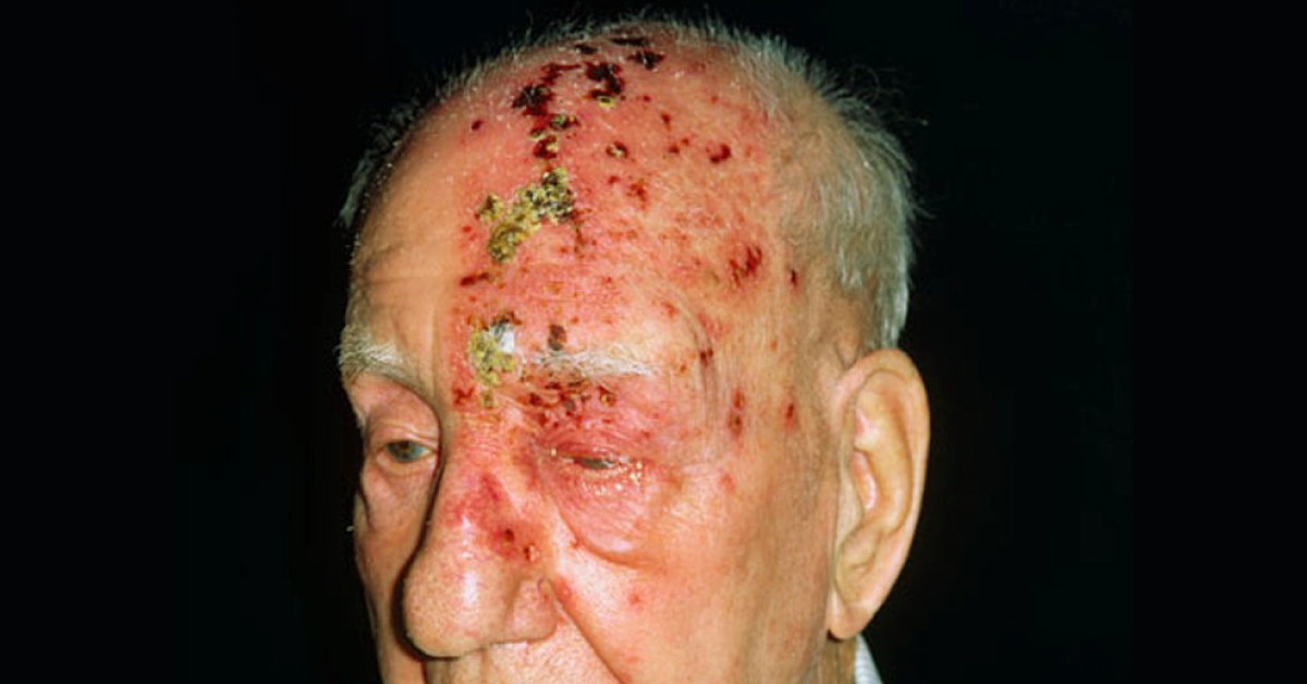 Post Herpetic Neuralgia, Advanced Managements