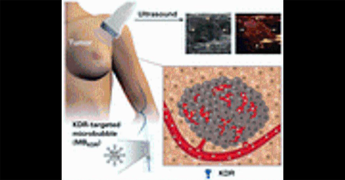 Ultrasound Can Detect Malignant Tissues By Molecular Imaging Biopsy