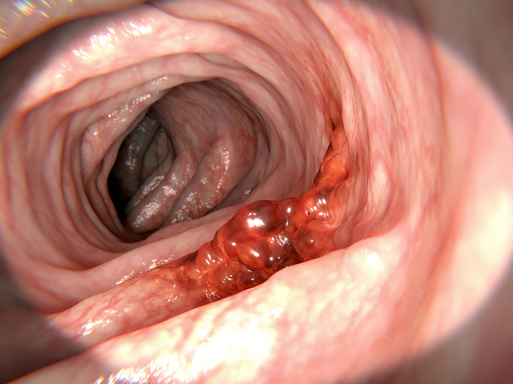 Moderate And High Risk Colorectal Cancer : British Society of Gastroenterology Guidelines