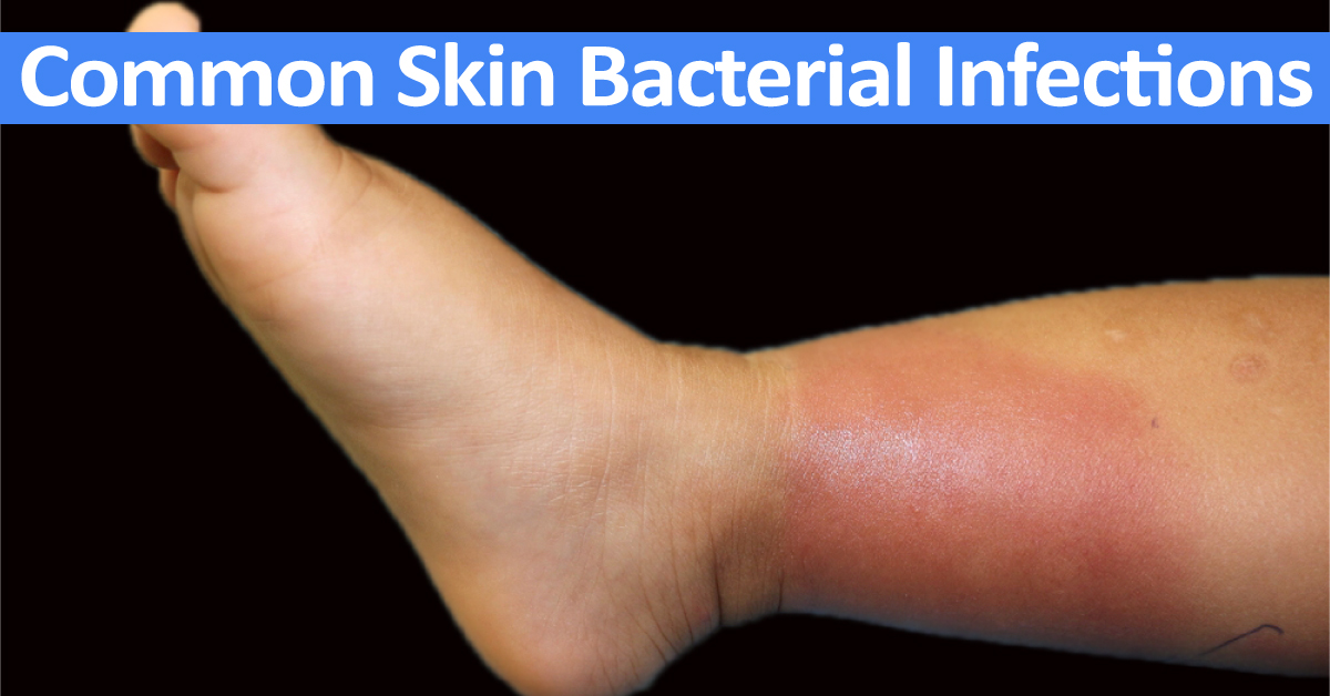 Treating Skin Bacterial Infections
