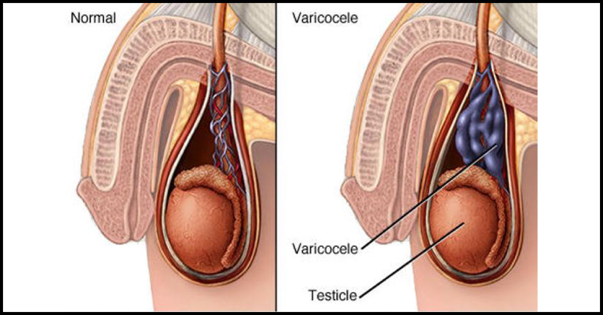 Management Of Varicocele In Infertile Or Subfertile Men