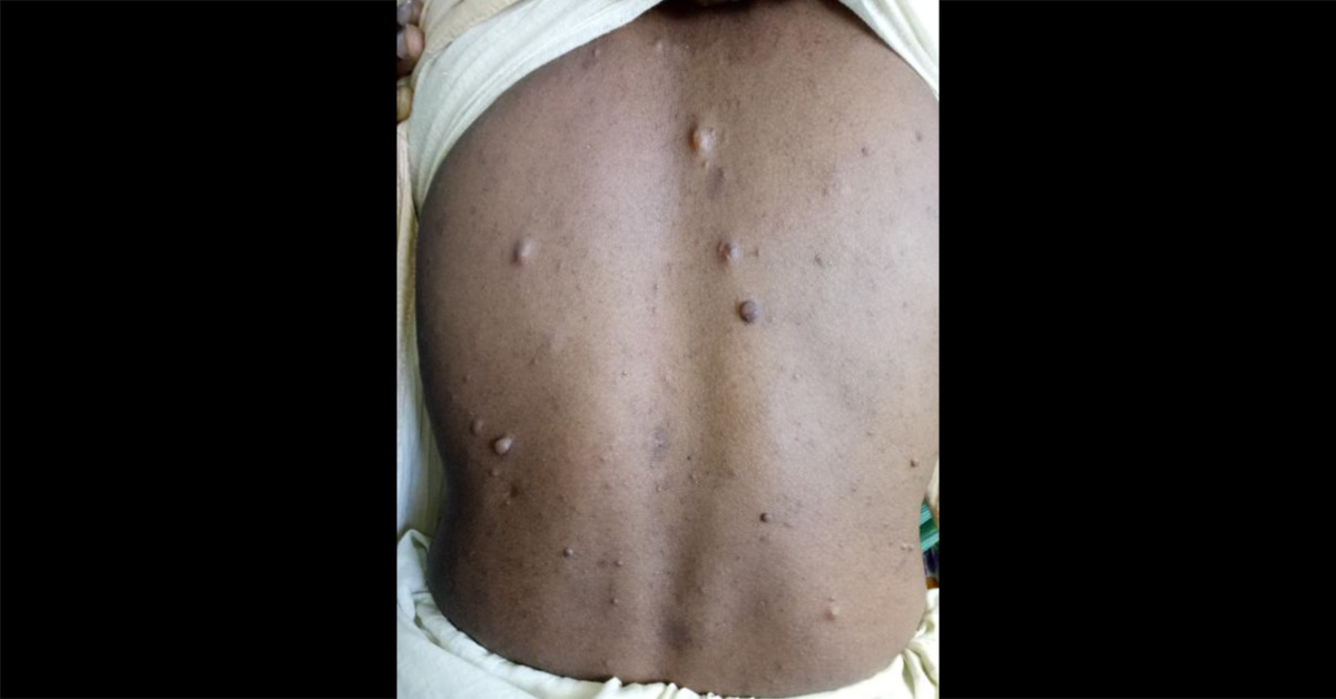 Advice Treatment For Gradually Increasing Lesions