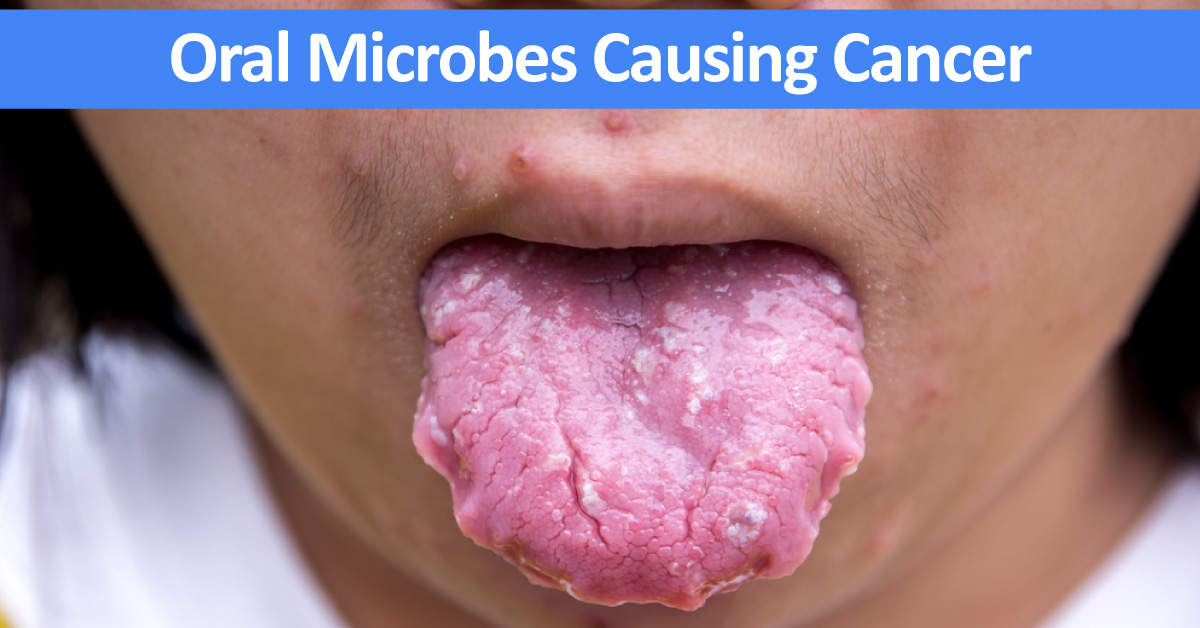Oral Bacteria Induce Cancer Throughout Body, Clinical Outcomes