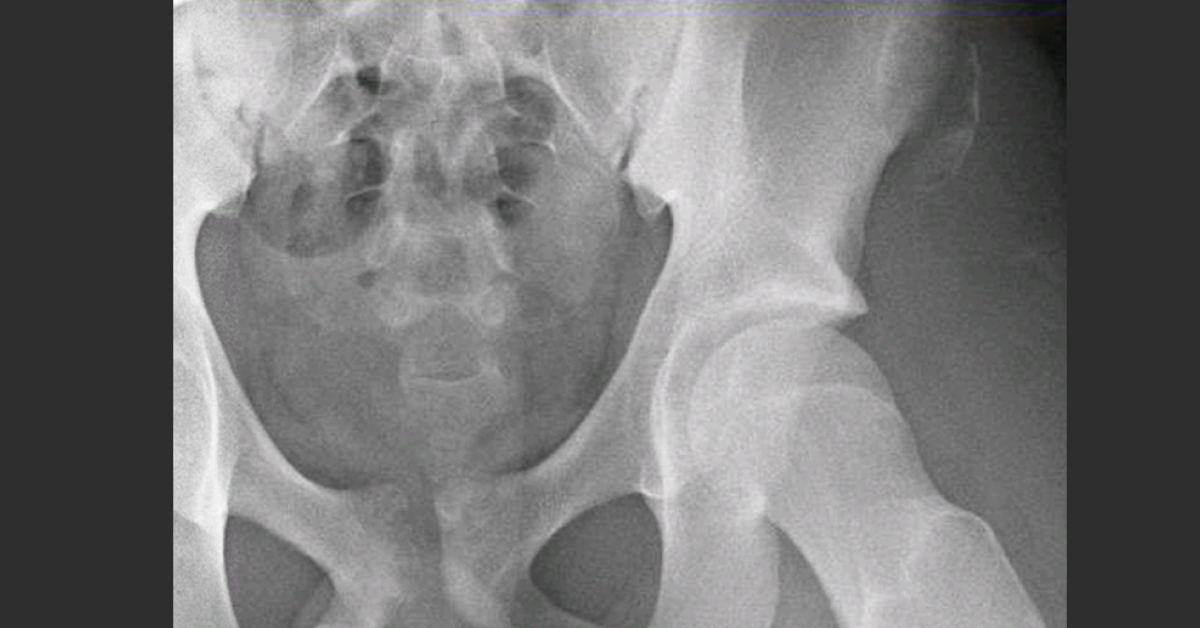 Diagnose The Hip Pain