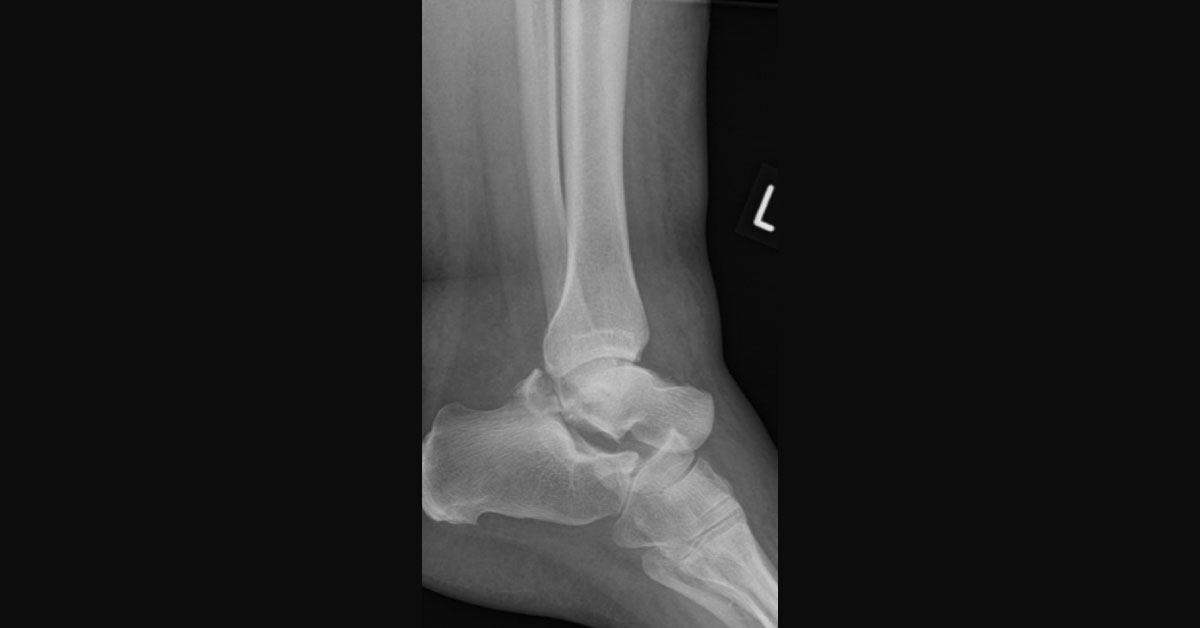 Identify Whats Wrong With The Ankle