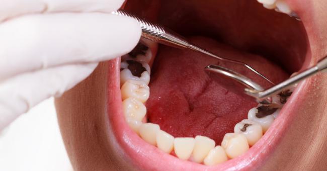 Dental Interventions to Prevent Caries in Children