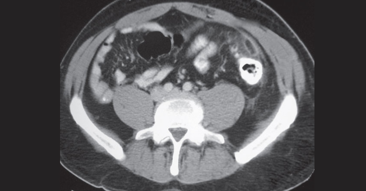 Identify The Condition Of Hypodense Pericolonic Oval Mass