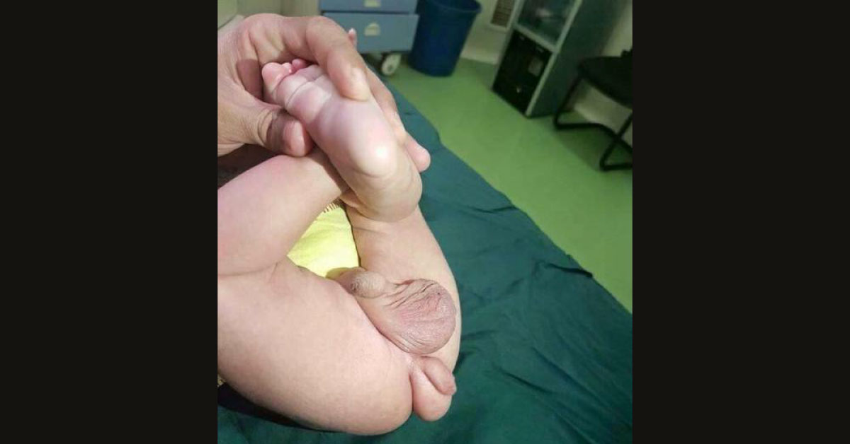Congenital Genital Anomaly