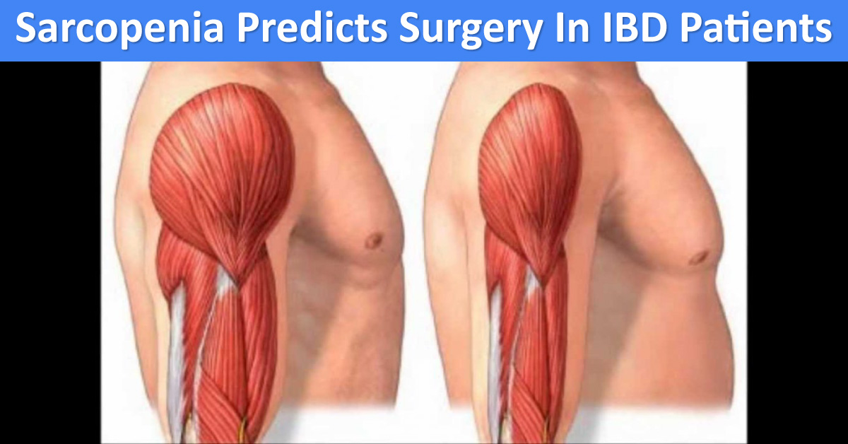 Sarcopenia Can Predict Surgery In Overweight IBD Patient