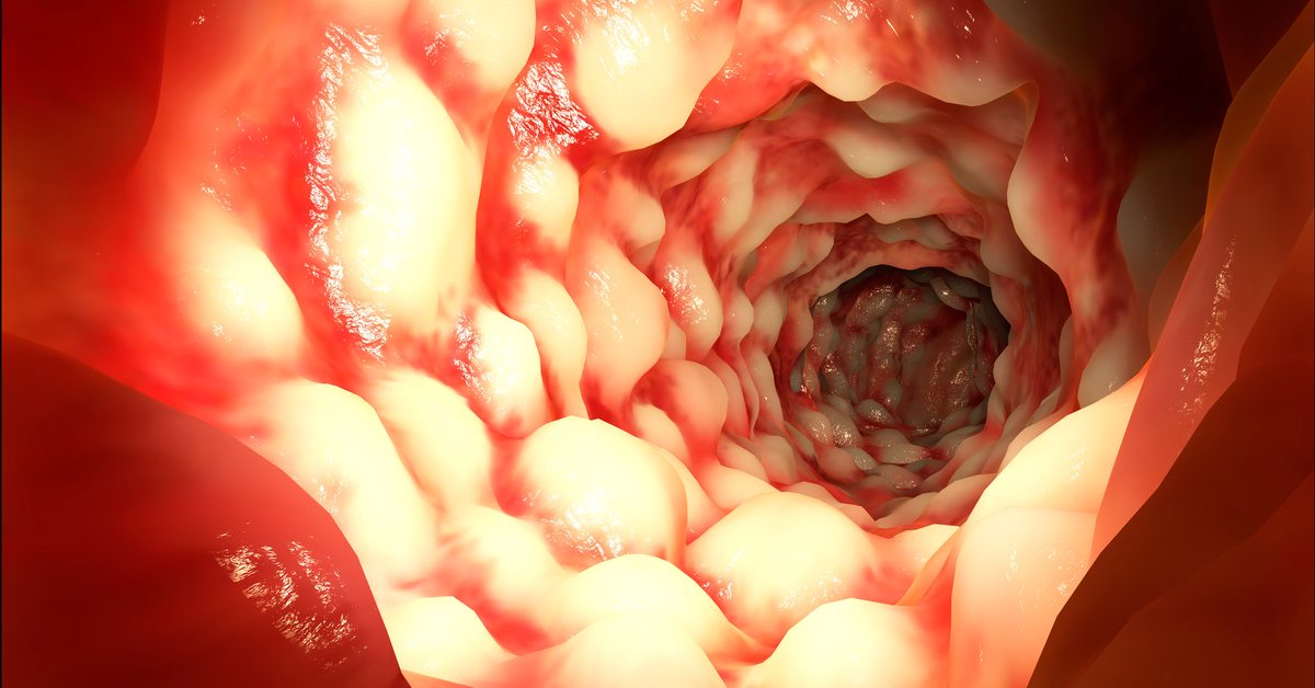 Beside Bacteria Now Fungus Is Also Found In Crohns Disease