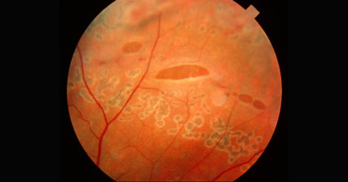 Diagnose The Ophthalmic condition