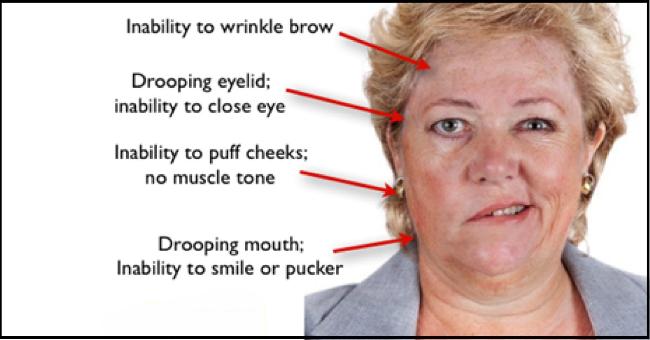 Steroids and Antivirals for Bell Palsy