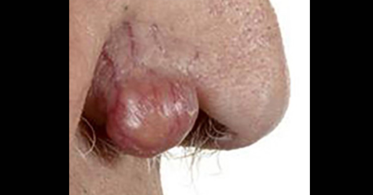 A Pedunculated Nasal Nodule