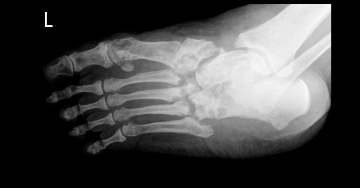 A Swollen Painful Foot