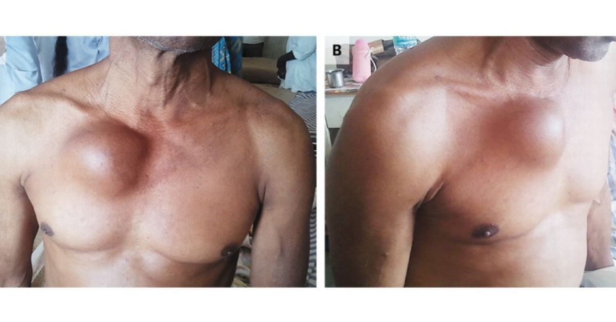 Pulsatile Chest Swelling