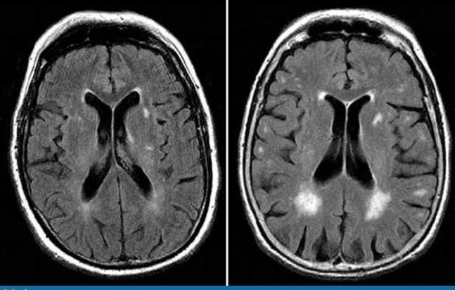Diagnose An Elderly Man With Tinnitus And Gait Ataxia