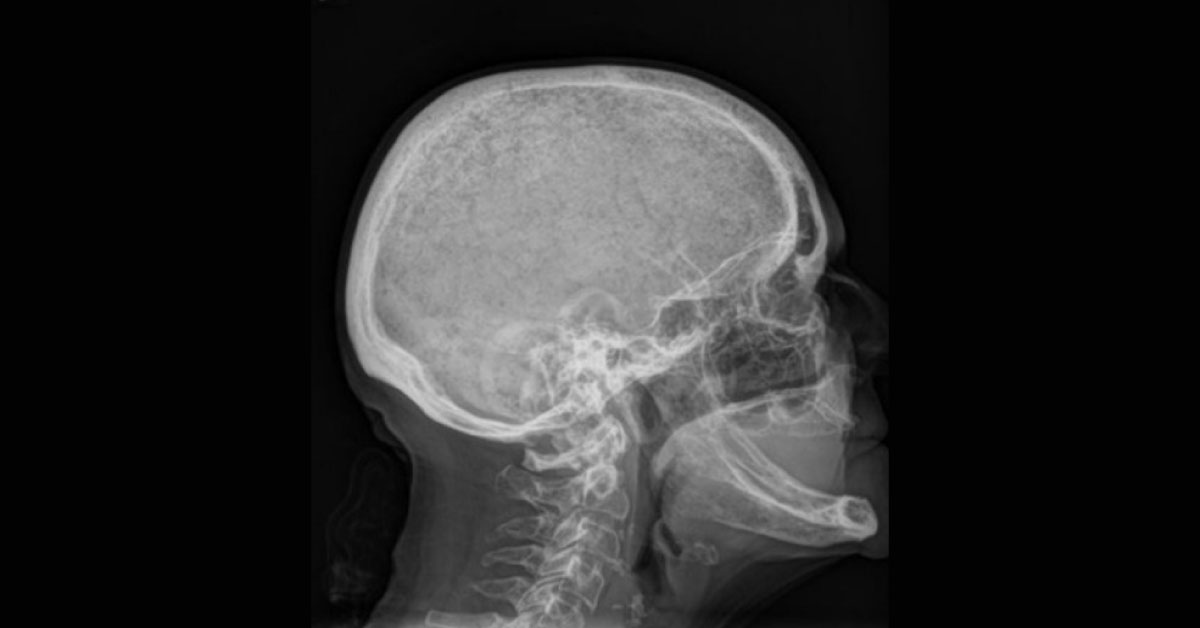 Abnormality In Skull Radiograph