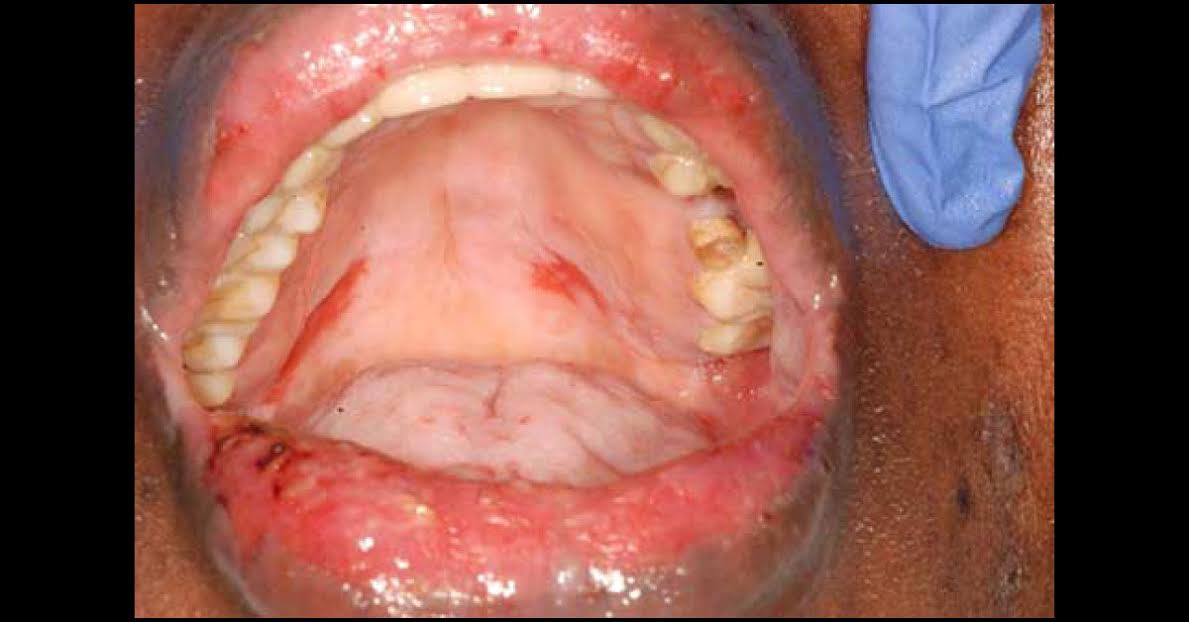 Diagnosis For Persistent Oral Ulcers
