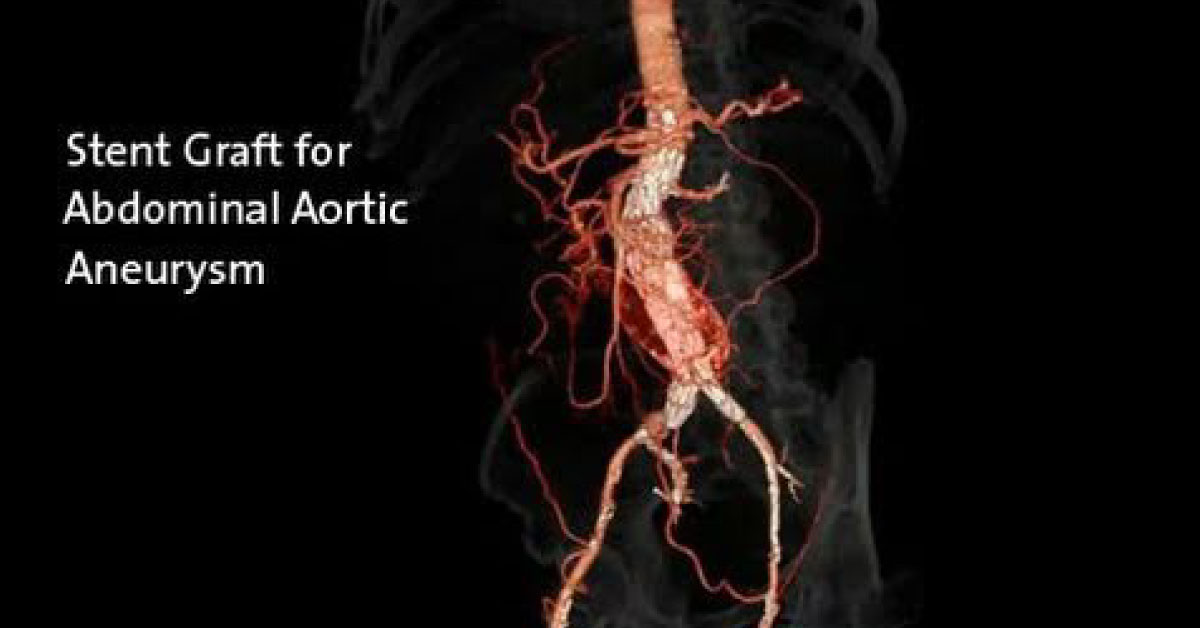 Stent graft placement in abdominal aortic aneurysm