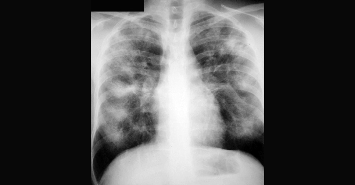 Chronic Cough In A Female