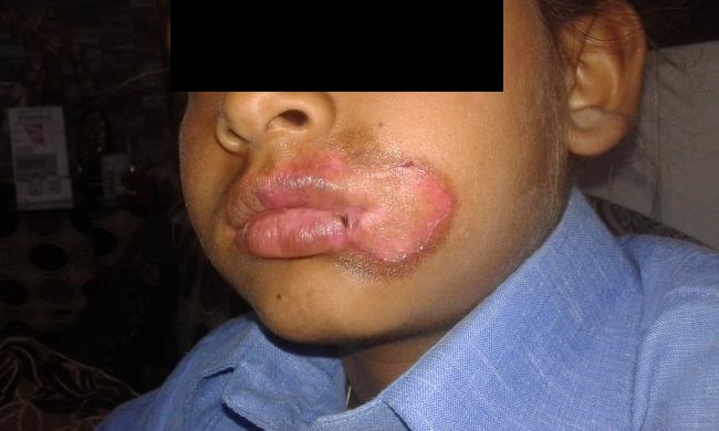 Diagnose The Plaque On Face