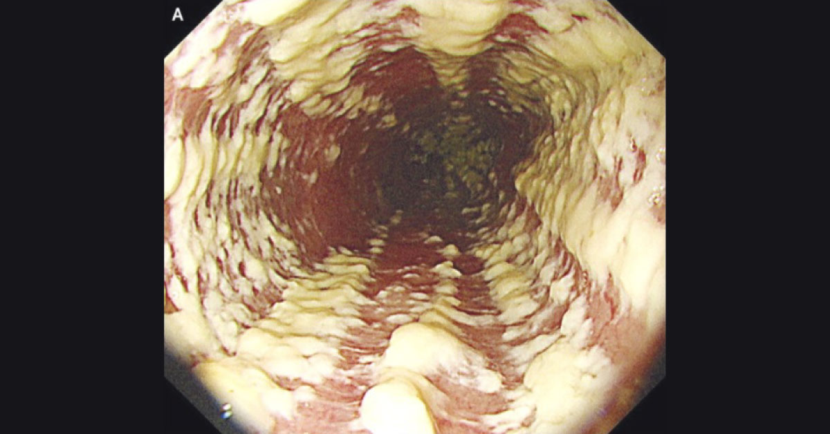 White Mucosal Plaque Like Lesions On Esophagus