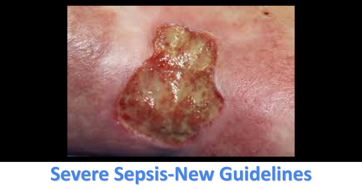 New Guidelines For Management Of Severe Sepsis