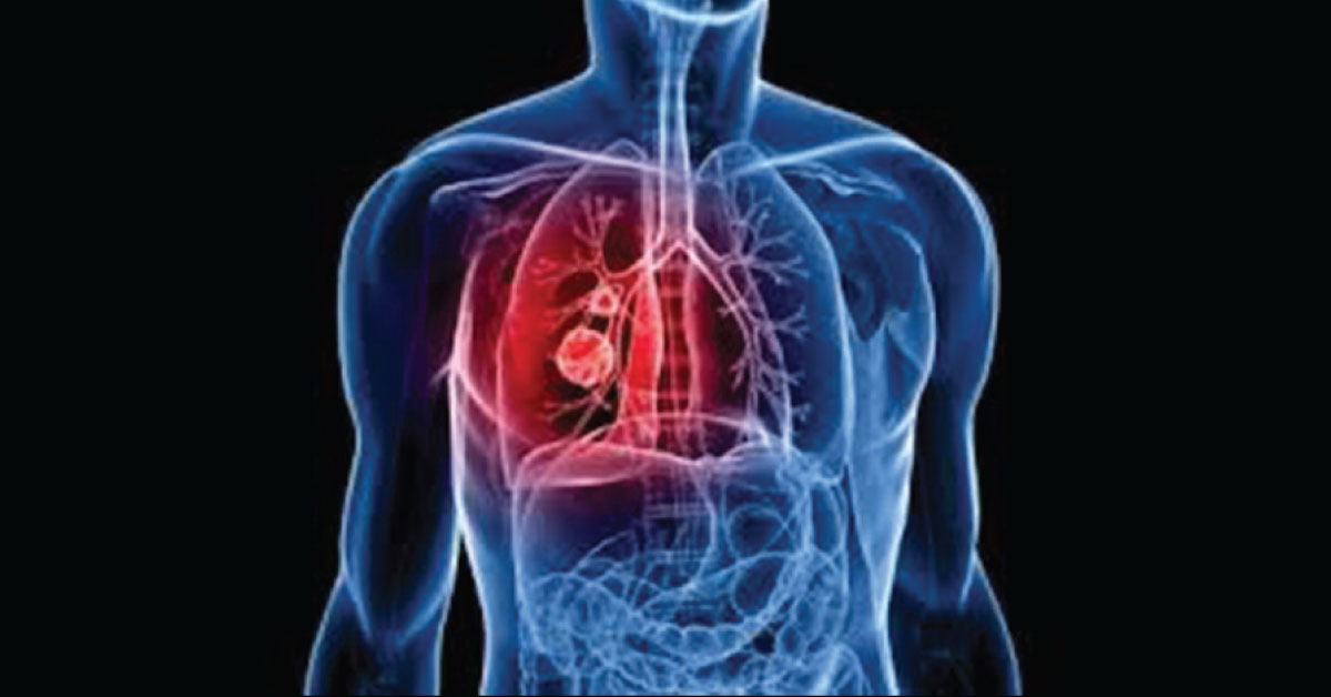 Adult Respiratory Distress Syndrome