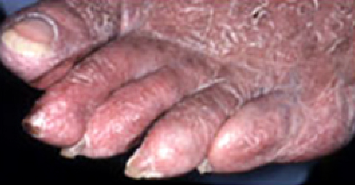 Diagnose The Dermal Condition