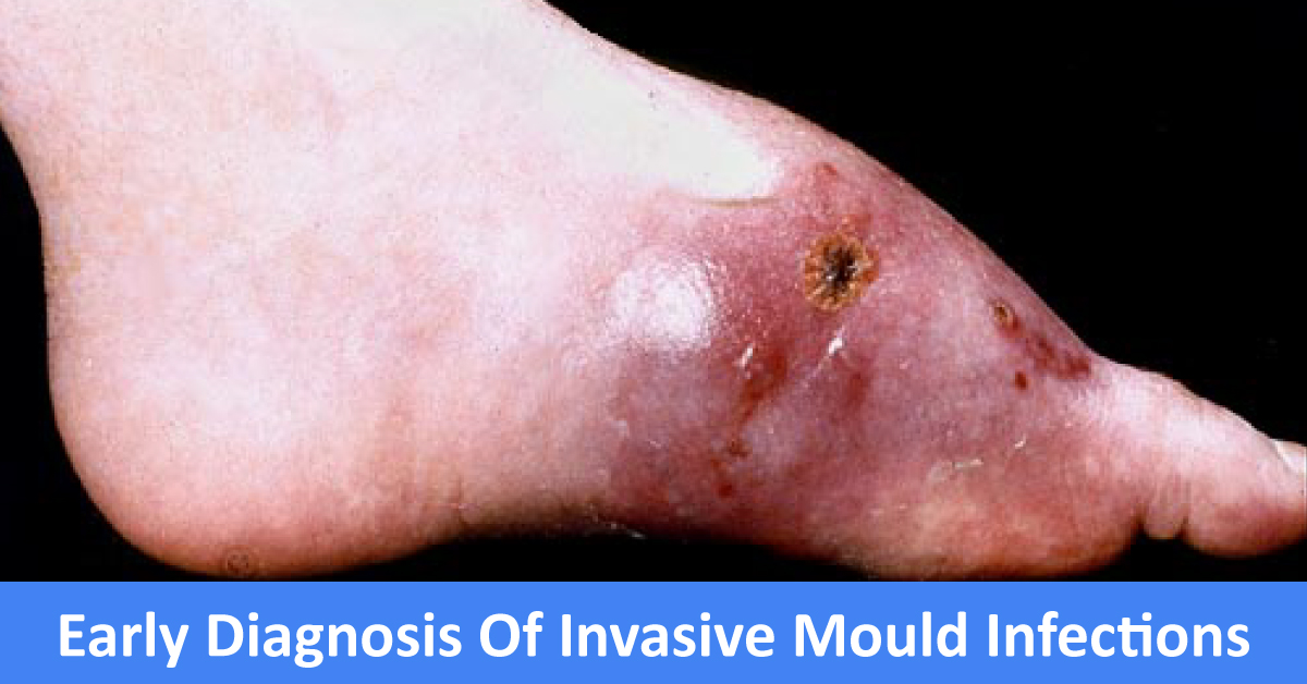 Early Diagnosis Of Invasive Mould Infections